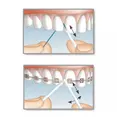 Флос Mirafloss Implant CHX Medium (2,2 mm) — Photo 1